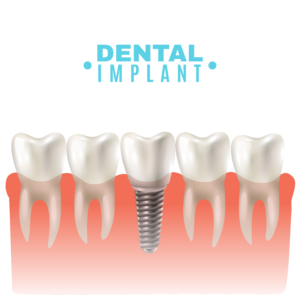 3D Guided Implant